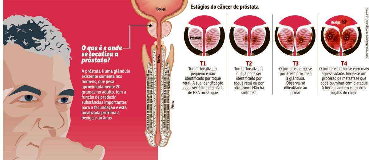 Cancro da Próstata - Tumores malignos próstáticos (da próstata)