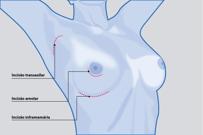 A inciso para colocao da prtese tambm varia de acordo com o perfil da mulher interessada na cirurgia. O corte pode ser feito em volta da arola, abaixo da mama ou prximo  axila. Apenas a conversa com o mdico poder definir o mtodo mais indicado.