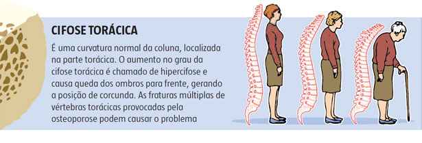 Estudo mostrou que os exercícios físicos podem evitar comprometimentos incapacitantes da osteoporose durante a menopausa, entenda