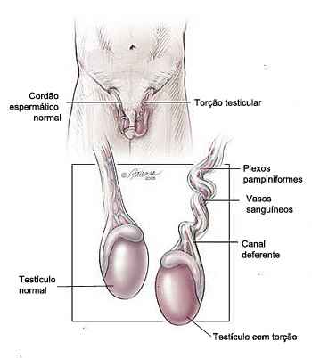 Dor nos testículos pós-treino pode vir de hérnia, infecção e até