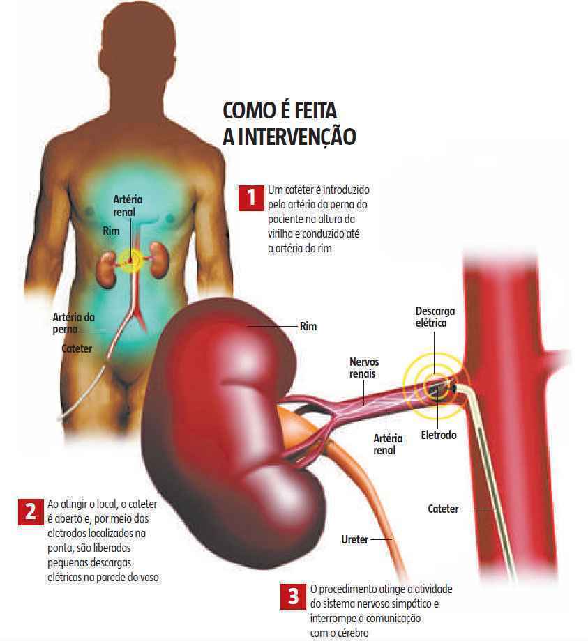 Serra, o cateterismo e a capa que Veja não deu