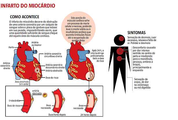 Quais são os principais sinais de infarto?
