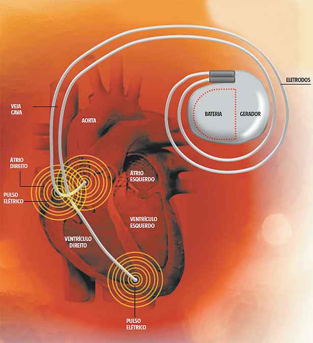 Confira o que muda na vida de quem tem marcapasso - Saúde