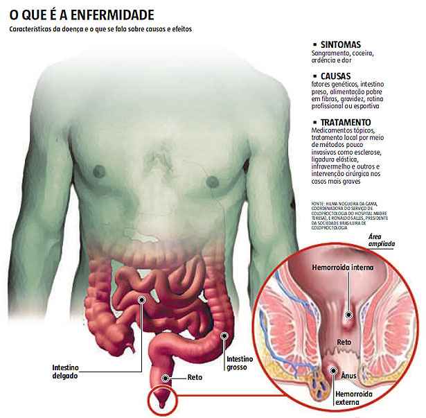 Sente dores fortes no ânus ou reto e não sabe o que é? Pode ser hemorroida,  doença caracterizada - InMeD