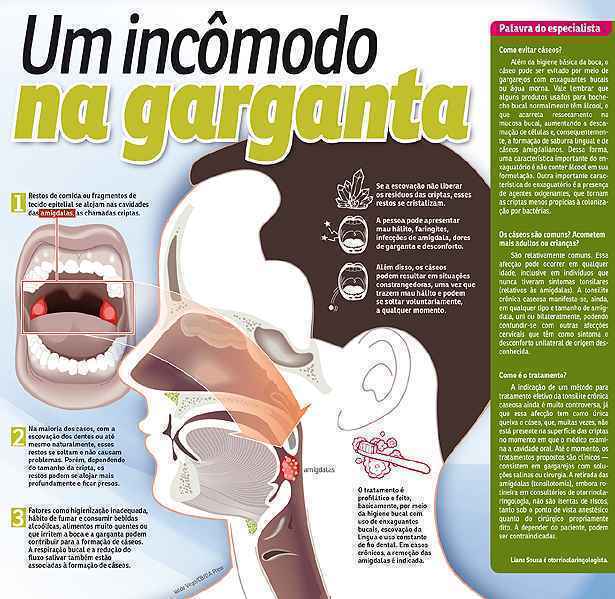 Bolinhas brancas na garganta? Entenda o que é a amígdala caseosa