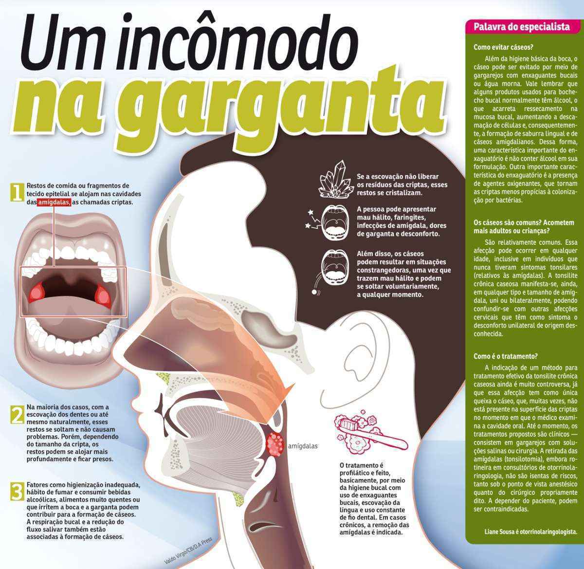 Cáseos amigdalianos, problema que segundo pesquisa pode afetar 30,3% da  população, tem opções de tratamentos conservadores, que mantêm as amígdalas