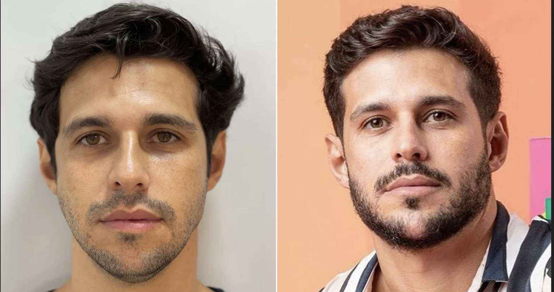 BBB22: Rodrigo fez harmonização facial antes de entrar no reality -  Realities